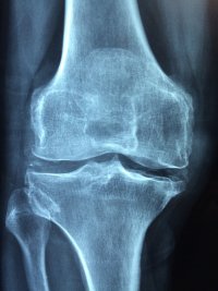 L'ostéoporose peut être lié à une carence en calcium